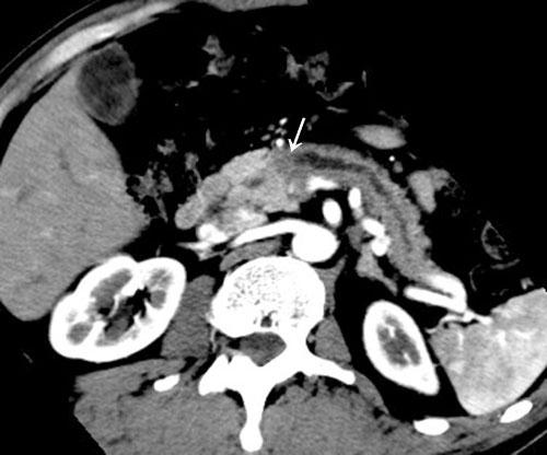 Imaging of early pancreatic cancer on multidetector row helical CT (a) (b) Figure 4. 50-year-old man with early pancreatic carcinoma measuring 19 mm (Case 7).