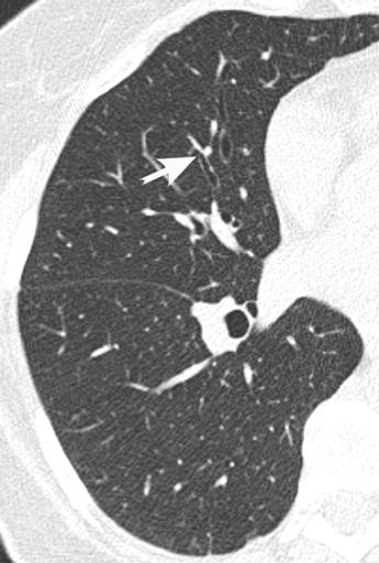 ity in all false-negative cases (three had consolidation, two had an apparent mass, and one had an apparent cavity), it did not depict the presence of bronchiectasis.