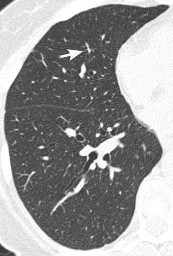 For example, in one study of 50 patients evaluated for suspected bronchiectasis, single-row helical CT found bronchiectasis in 90 lung segments compared with 77 segments with HRCT [8].