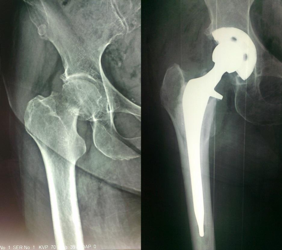 Parcijalna artroplastika kuka nakon preloma femura Slika 8.