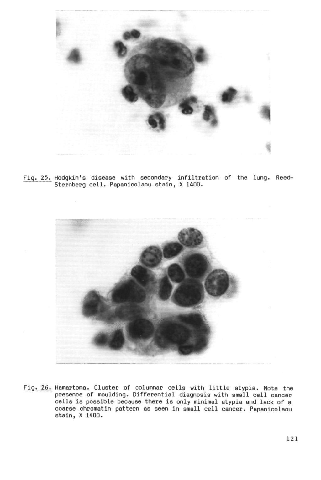 Fig. 25. Hodgkin's disease with secondary infiltration of the lung. Reed- Sternberg cell. Papanicolaou stain, X 1400. Fig. 26. Hamartoma. Cluster of columnar cells with little atypia.