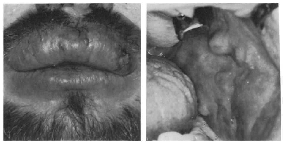 MELKERSSON-ROSENTHAL SYNDROME AND CROHN S DISEASE 255 stipulated for M.R.S. in the present study: permanent swelling of labial and/or buccal mucosa and presence of non-caseating epithelioid cell granulomas.