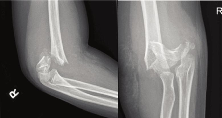 Fig. 1: Supracondylar fracture with comminution in an older child aged >7 years. Fig. 2: Supracondylar fracture with no comminution in a child aged <7 years.