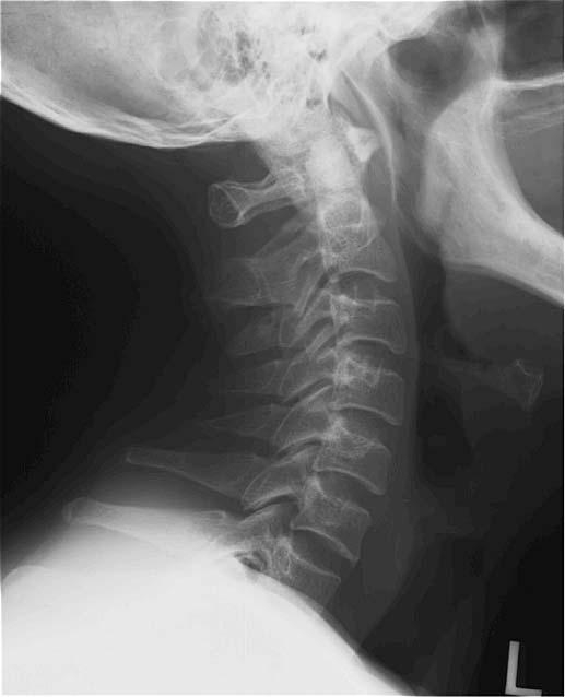 There were no findings of cervical spondylosis by cervical X ray. the total cholesterol level is associated with carotid atherosclerosis (10).