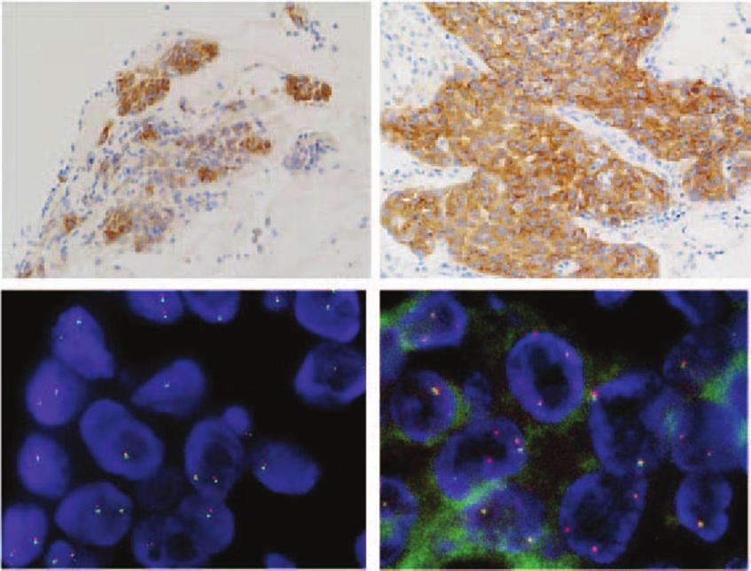 Journal of Thoracic Oncology Volume 10, Number 5, May 2015 Heterogeneity of ALK Gene Rearrangement in NSCLC A IHC FISH B IHC FISH Biopsy Positive Equivocal: 9% Excision Positive Positive FIGURE 3.