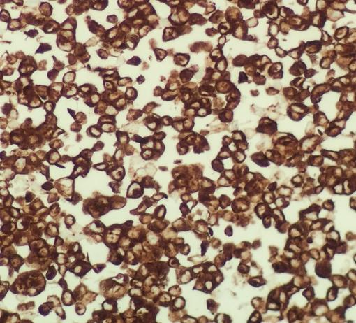 5. Expected Staining Results for ALK-Lung The following section gives micrographs of the expected results obtained with each of the