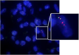 5.2 ALK translocation Fluorescence in situ hybridization: Abbott Molecular, Vysis ALK Break Apart