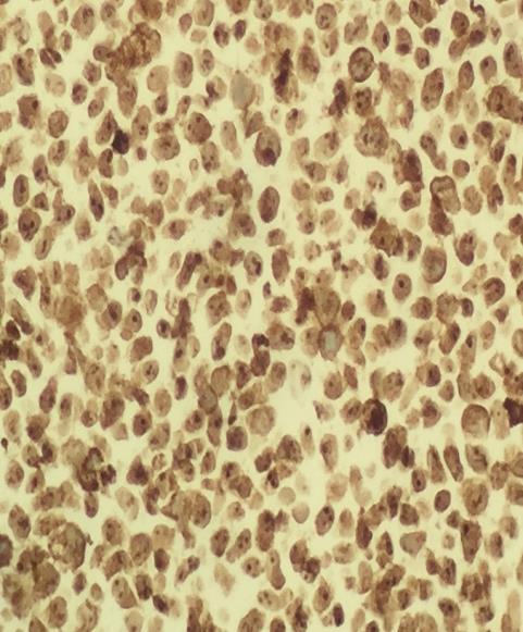 7. Expected staining results for ALK-Lymphoma The following section gives micrographs of the expected results obtained with