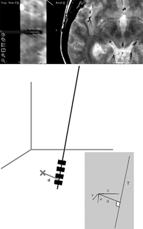 Avoiding the ventricle improves DBS targeting accuracy Fig. 2. A: Axial stereotactic T1-weighted MR images obtained in a patient at the Los Angeles center.