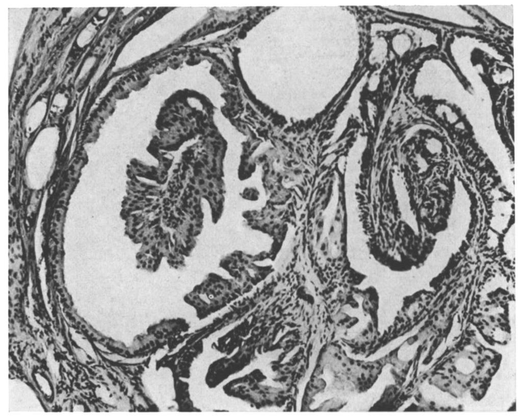 The acini that show papillary infoldings and lined by cells with clear cytoplasm represent apocrine glands.