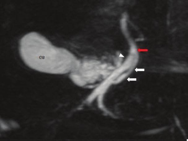 Figure 3: Coronal oblique 3D MR cholangiopancreatography shows low medial insertion of cystic duct where cystic duct (arrow) drains at lower 3rd of CHD from left side.