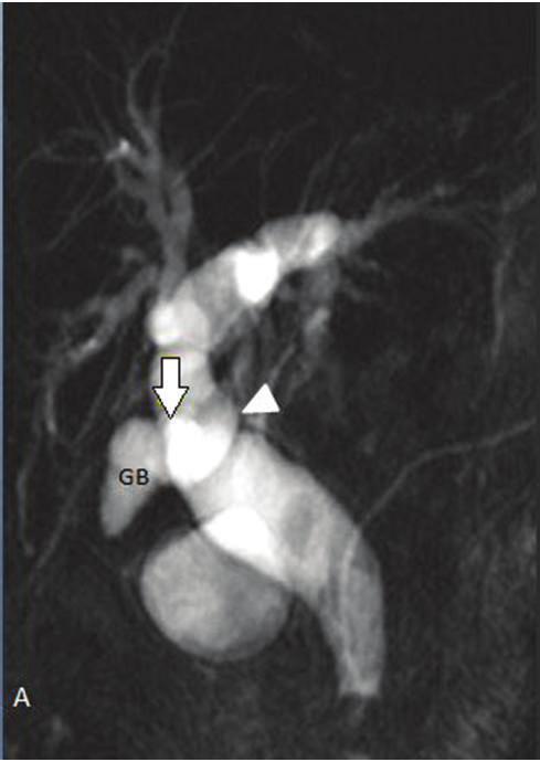 4 Radiology Research and Practice (a) (b) Figure 6: (a) Coronal oblique 3D MR cholangiopancreatography.