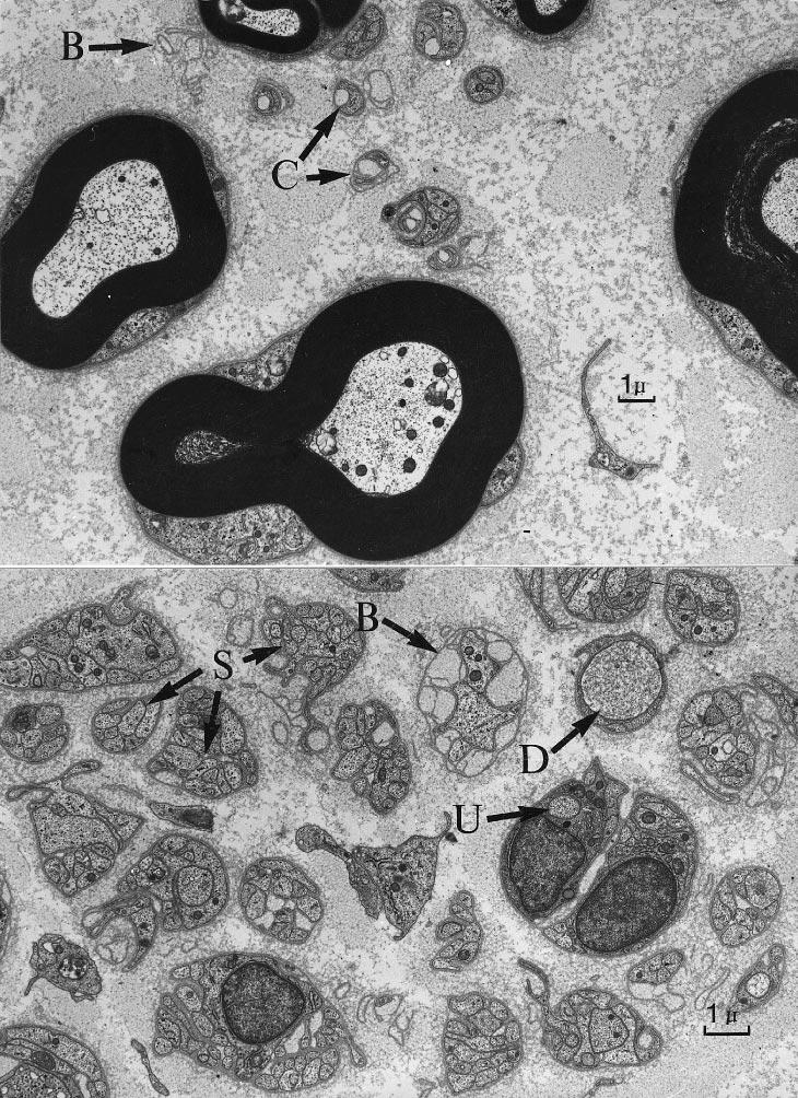 67 Fig. 3 Patient 5: electron micrographs of thin section of the nerve specimen to illustrate degeneration of unmyelinated fibres.