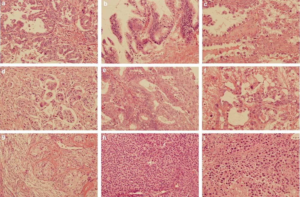 Matriptase in ovarian tumors 449 Figure 1 Hematoxylin and eosin staining of serous adenocarcinoma (a), mucinous adenocarcinoma (b), clear cell adenocarcinoma (c), transitional cell carcinoma (d),