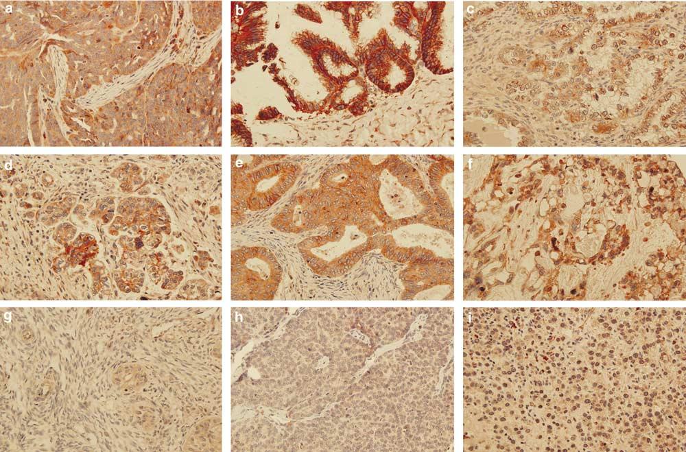 Matriptase in ovarian tumors 45 Figure 2 Immunohistochemical analysis of serous adenocarcinoma (a), mucinous adenocarcinoma (b), clear cell adenocarcinoma (c), transitional cell carcinoma (d),