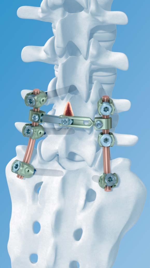 MATRIX Spine System