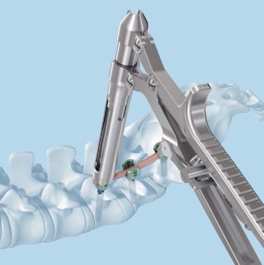 the implant. Squeeze the handle to seat the rod into the head of the pedicle screw.