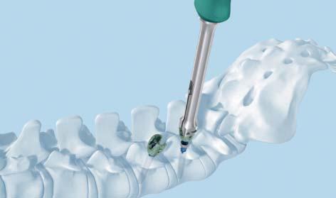 Retrieve a polyaxial head from the implant module, by