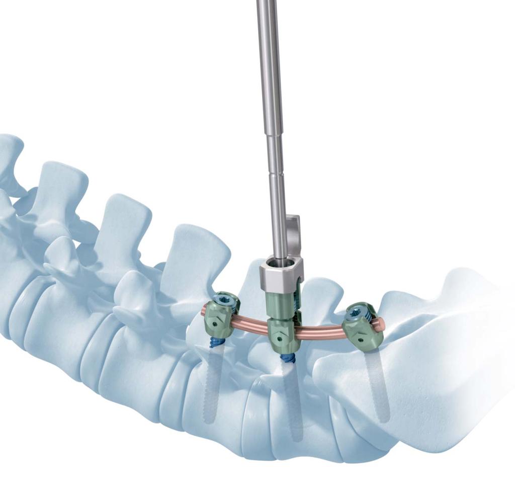 MATRIX Spine System Degenerative. A posterior pedicle screw and rod fixation system.