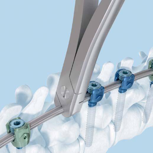 The coronal benders can be used to contour the rod in the coronal plane. 10 Correct deformity with rod rotation (optional) If rod rotation is desired, the following options may be used.