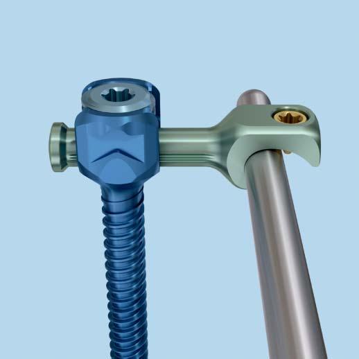 Optional Techniques Transverse bar attachment (monoaxial only) The transverse bar provides an extension to the monoaxial screw in situations where the rod contour or patient anatomy prevents a direct