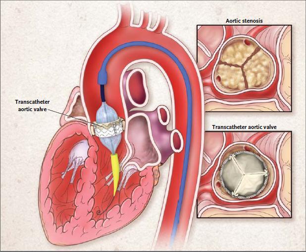 Transcatheter aortic-valve