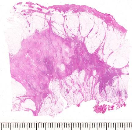 Clinical presentation, mammographic appearance and outcome: - Classic invasive lobular carcinoma: the