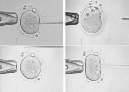 Aurell R, Belil I, Veiga A, Barri PN Intracytoplasmatic Sperm Injection (ICSI) Spermatozoa sometimes fail to fertilize an egg during conventional IVF.