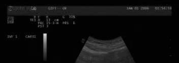 Spirotome - Ultrasound Surgery: