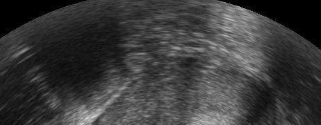 ultrasound TVS