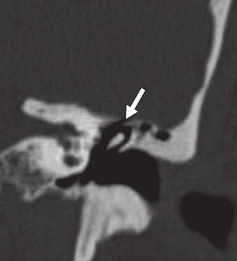, Sagittal T reformation of petrotympanic fissure (arrow) shows that it connects middle ear with