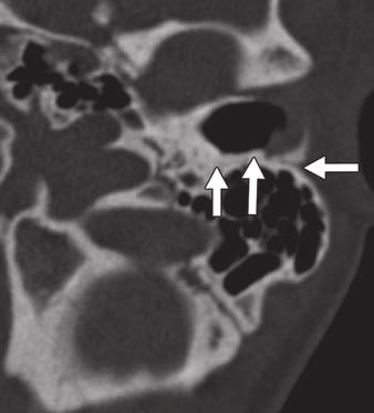 Petrosquamous fissure can be difficult to visualize on axial T.