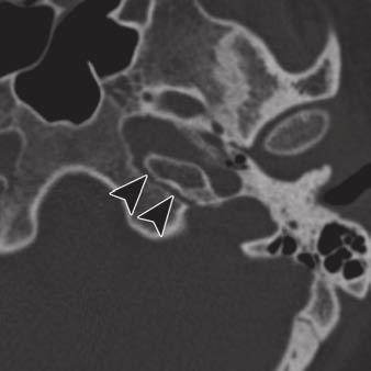 , T image of 23-year-old woman shows petrooccipital suture contains inferior petrosal sinus.