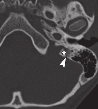 , On T image of 46-year-old man with fracture of occipital bone (white arrows), petrooccipital suture (black arrows) can be differentiated from