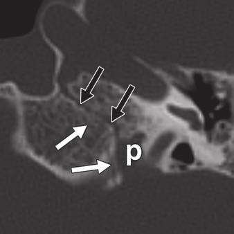T image shows sphenopetrosal suture (white arrowheads) courses between greater wing of sphenoid bone and petrous apex.