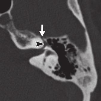 , T image of 61-year-old woman shows petromastoid canal (arrow) has characteristic anterior convex course from posterior fossa