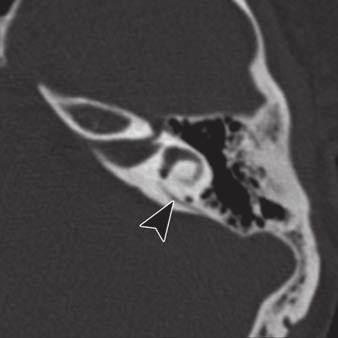 aliber of petromastoid canal is usually equal to or less than that of corresponding vestibular aqueduct.
