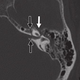 separate because of its characteristic course. Fig. 9 Hiatus of facial canal., T image of 44-year-old woman.