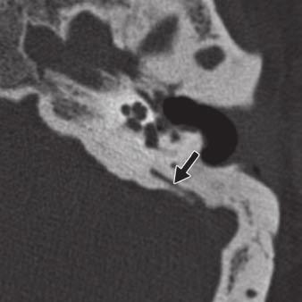 Temporal one Fracture Mimics on T Downloaded from www.ajronline.org by 37.44.198.