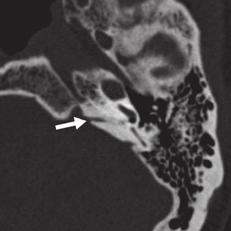 , T image shows cochlear aqueduct (arrow) arises from region of round window (arrowhead).