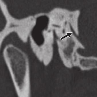 of internal acoustic canal., T image shows medial end of cochlear aqueduct (arrow) is wider and funnel-shaped.