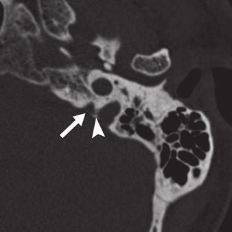 glossopharyngeal nerve to pars nervosa of jugular foramen. rrowhead indicates spine of jugular foramen. Fig.