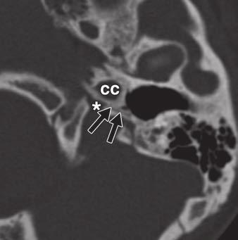Kwong et al. Fig. 14 Inferior tympanic canaliculus in 13-year-old girl.