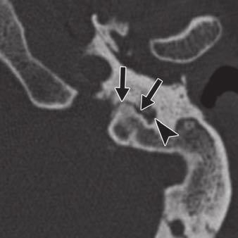 tympanic canaliculus (arrows) between jugular foramen and carotid canal (cc).
