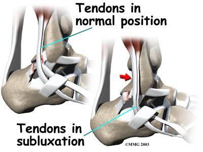 If the supportive tissue has been damaged or injured, the tendon may be free to slip out of its normal position. This is called subluxation.