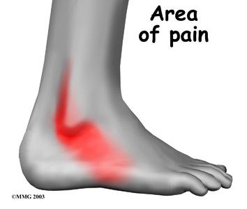 Symptoms What does peroneal tendon subluxation feel like? Patients describe a popping or snapping sensation on the outer edge of the ankle.