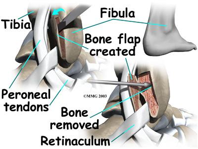 In this procedure, the surgeon first makes an incision along the back and lower edge of the fibula bone. The surgeon cuts a small flap in the bone near the bottom corner of the fibula.