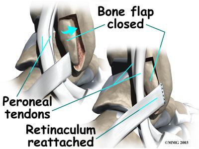 Next, the tendons are returned to their location behind the tip of the fibula. Repair of the retinaculum may also be required with this procedure (see above). The skin is closed and sutured.