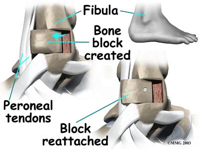 strength and coordination in the ankle. After Surgery the bone. A special tool is used to cut this small section of the fibula. The cut only goes partway through the bone.