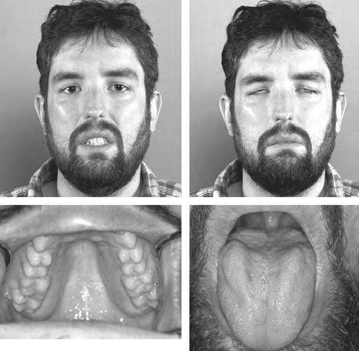 MG Examination: Facial Weakness l Orbucularis oculi: Weak forced eye closure l Depressed or expressionless facial expressions l Myasthenic snarl with attempted